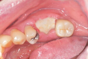 オープンバリアメンブレン（CYTOPLAST TXT）を用いた歯根破折歯の抜歯
